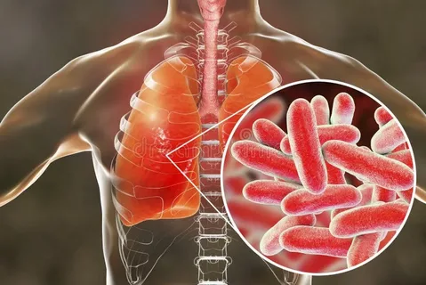 Legionnaires’ Disease